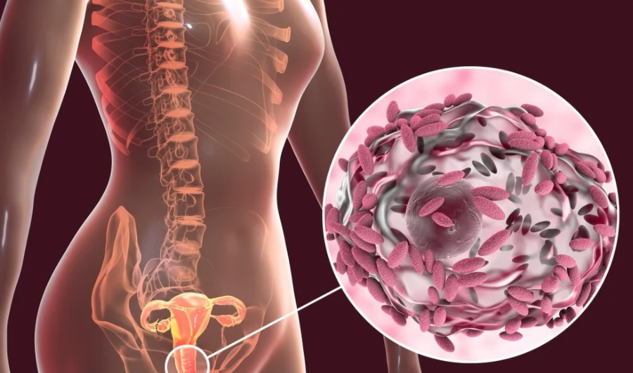 Bacterial Vaginosis | Diagnosis, Symptoms, Treatment And Preventive Measures